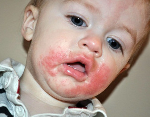 alergi pada anak